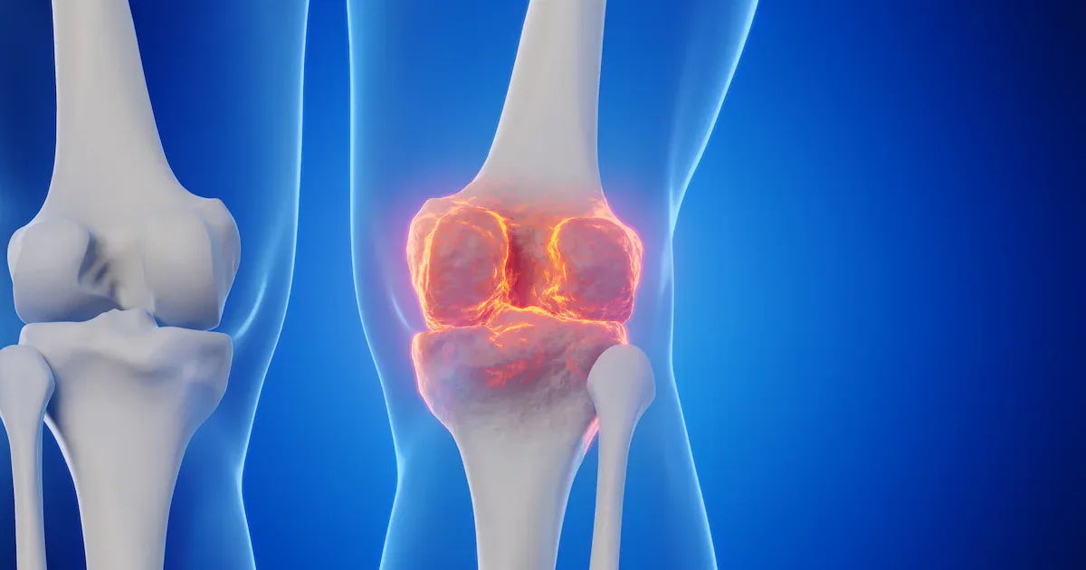 Gelenkgesundheit durch Ernährung: Was Orthopäden wirklich empfehlen