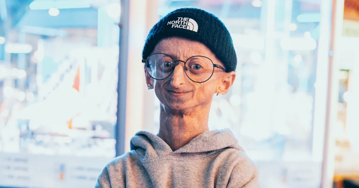 Michiel Vandeweert: Influencer stirbt mit 28 Jahren an Progerie
