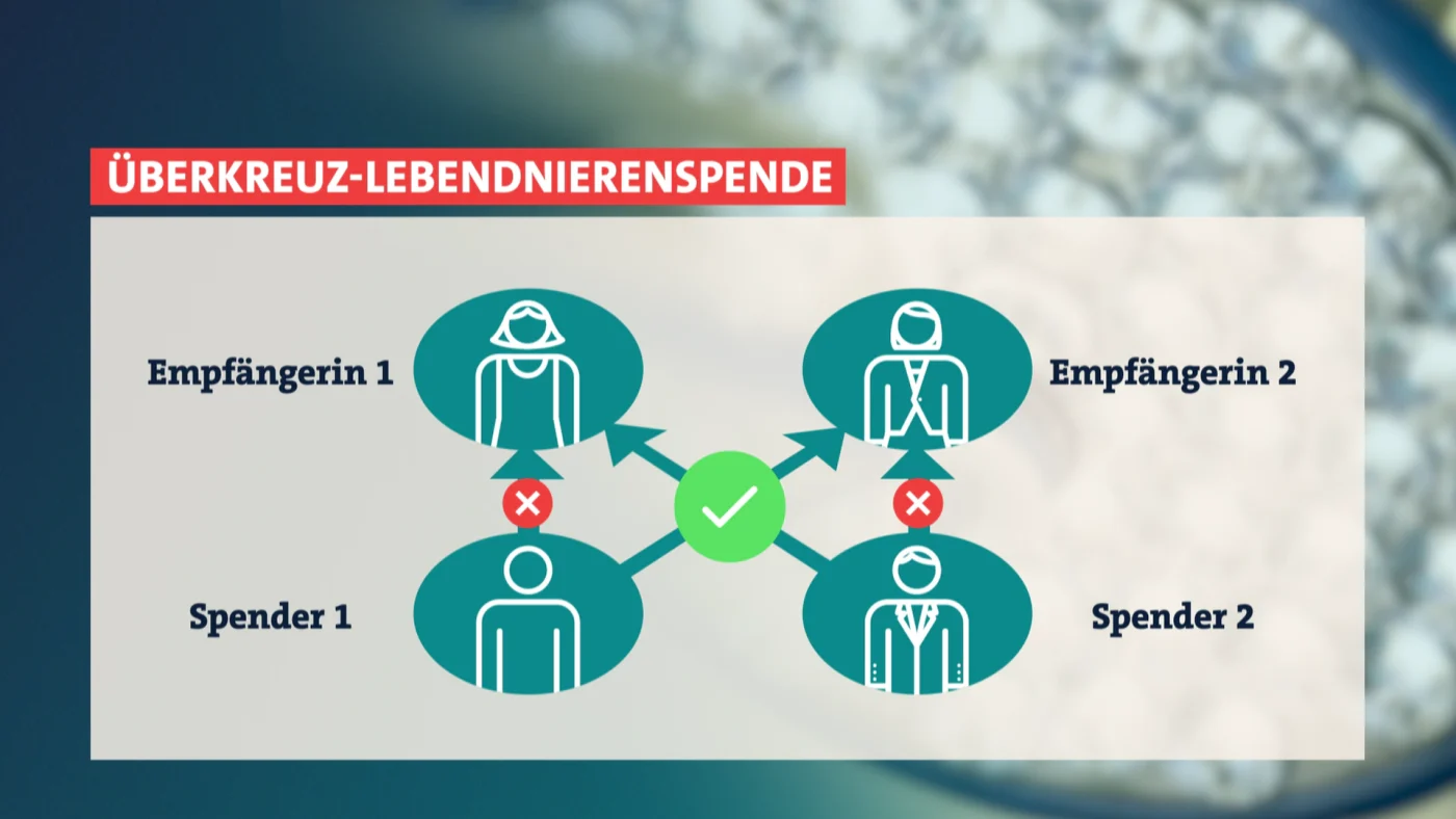 Bei der Crossover-Nierenspende spenden zwei Paare sich gegenseitig eine Niere.