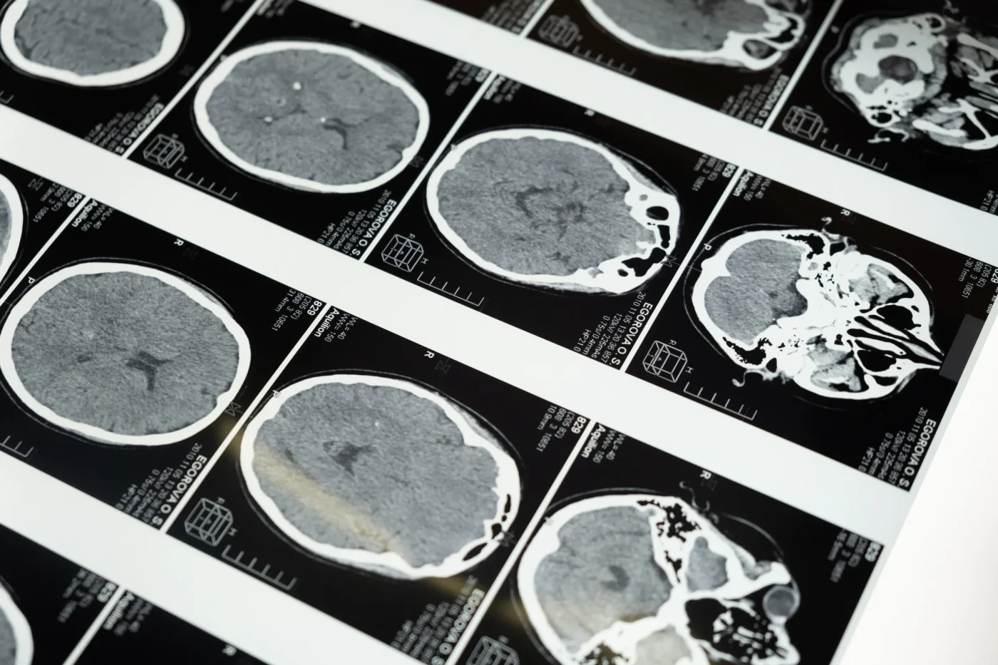 Was bedeutet die Diagnose Zerebralparese medizinisch?